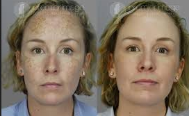 Hair Restoration Progress